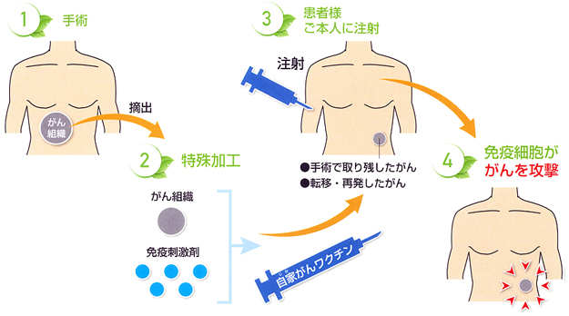 自家がんワクチンの工程